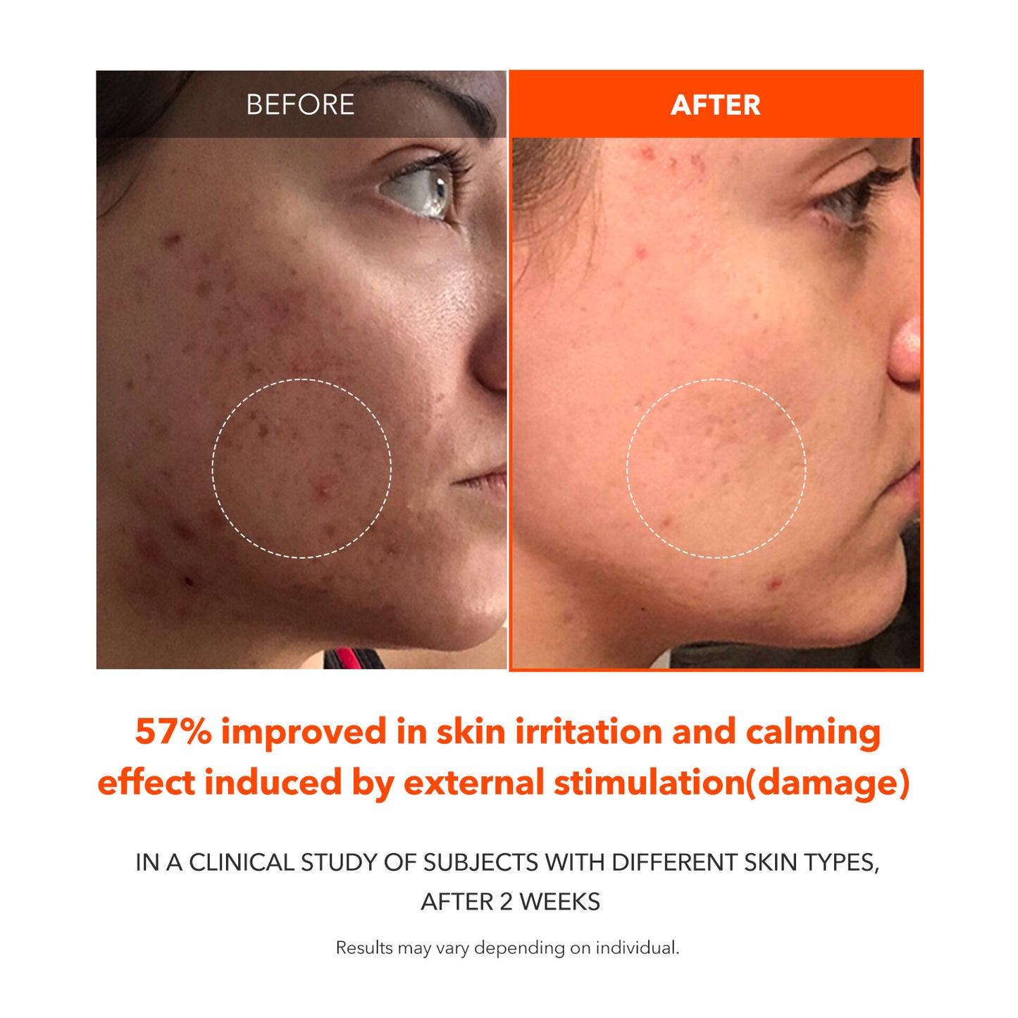 Carrotene Clarifying Serum (Pimple Serum) 30ml