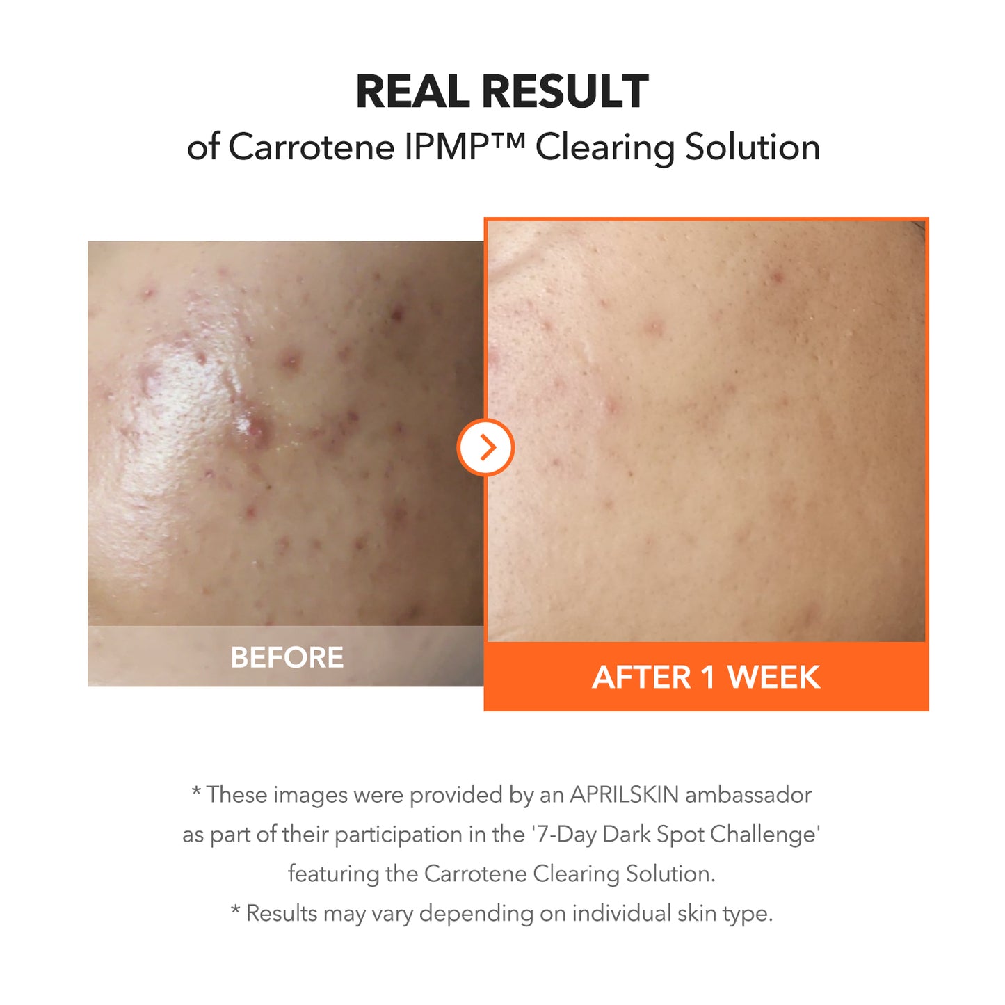 Carrotene IPMP™ Clearing Solution - APRILSKIN SG